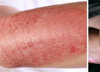 Αυτοάνοσα νοσήματα: 5 τροφές που θα περιορίσουν τα συμπτώματα