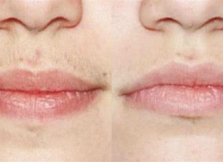 Φυσική συνταγή με 3 απλά υλικά που θα σας απαλλάξει από την ανεπιθύμητη τριχοφυΐα στο πρόσωπο, μια για πάντα