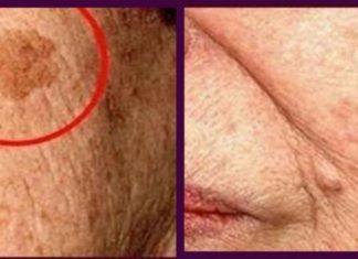 Μαγειρική σόδα: 5 σπιτικές θεραπείες για να απομακρύνετε…