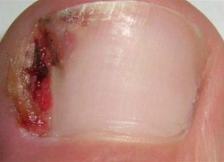 7 θαυματουργές θεραπείες για να απαλλαγείτε από τις παρανυχίδες και τα νύχια που παίνουν μέσα στο δέρμα