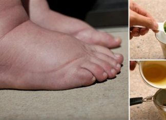 Τα πόδια της μελάνιαζαν και πρήζονταν κάθε βράδυ – Τότε δοκίμασε συνταγή με μέλι και ένα φυτικό συστατικό…