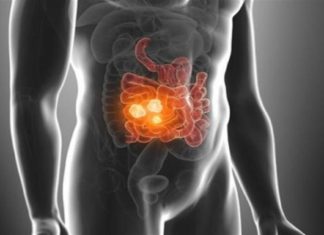 Καρκίνος εντέρου: Ποια τροφή σκοτώνει το 75% των όγκων