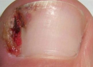 7 θαυματουργές θεραπείες για να απαλλαγείτε από τις παρανυχίδες και τα νύχια που παίνουν μέσα στο δέρμα