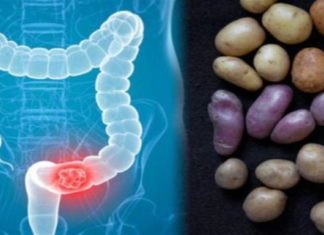 Καρκίνος του παχέος εντέρου: Πώς συνδέεται με τις πατάτες που τρώμε;