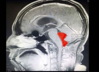 Άνδρας ζούσε με φρικτούς πονοκεφάλους και έκανε εμετούς! Μόλις πήγε στους γιατρούς έμειναν με το στόμα ανοιχτό!