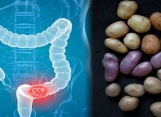 Καρκίνος του παχέος εντέρου: Πώς συνδέεται με τις πατάτες που τρώτε